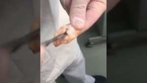 Эпителиальный копчиковый ход