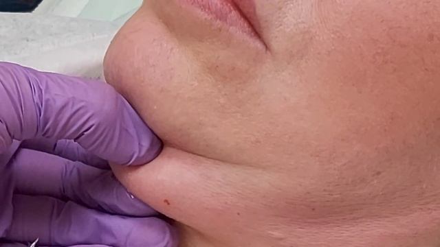 Инъекции липолитиков, предназначенных для уменьшения объема жировой ткани. смотреть онлайн