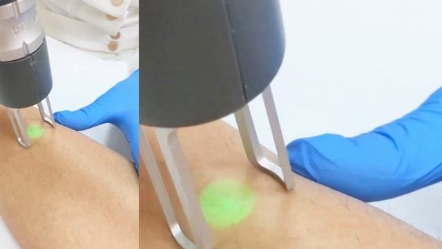 Лазерная эпиляция в Калининграде: александрит смотреть онлайн