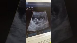 УЗИ на 12 недели!