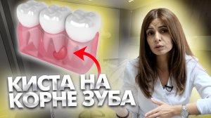 Если обнаружена киста на корне зуба, лечить или удалять?