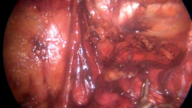 Laparoscopic Inguinal Hernioplasty. TAPP. Лапароскопическая герниопластика  прямой паховой грыжи.