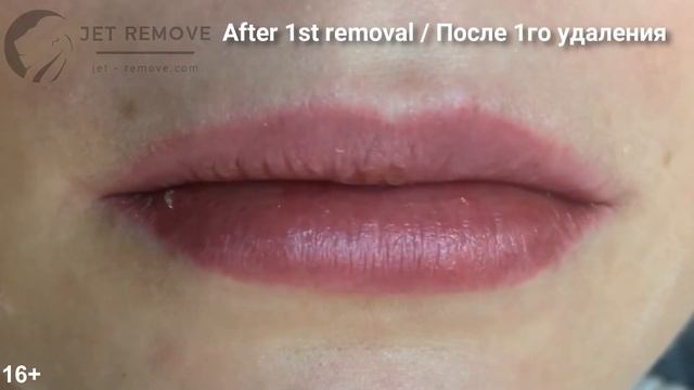 Удаление татуажа губ, плотный прокрас, ремувером Jet Remove. смотреть онлайн