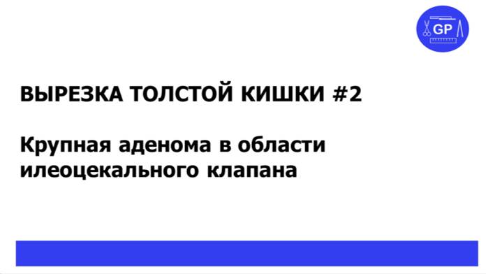 Рак толстой кишки #2 - гистологическое исследование