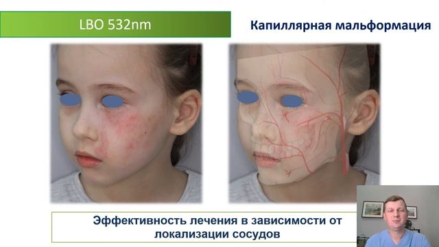 Сосудистая патология. Cutera Excel V