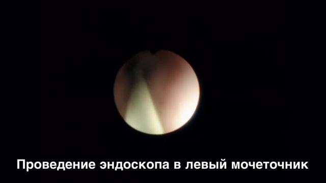 Эндоскопическое дробление камня мочеточника/Ureterolithotripsy смотреть онлайн