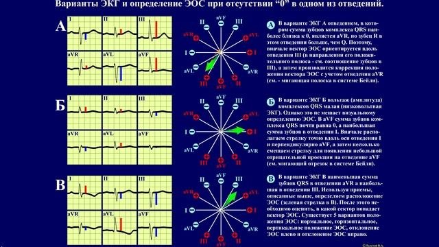 Тема 22.2. Электрическая ось сердца (ЭОС). Определение ЭОС по таблицам и визуальное (тренинг)