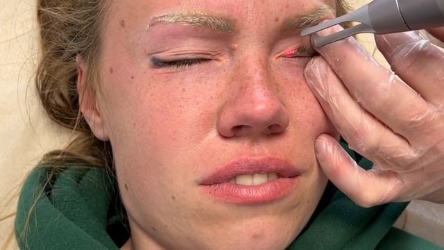 Видалення татуажу повік(стрілки - нижні і верхні)лазером надкороткого імпульсу Pico-Light Brilliant смотреть онлайн