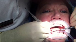 Имплантация зубов. Москва