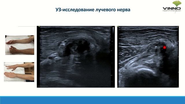 Ультразвуковая диагностика патологии тканей опорно-двигательного аппарата на клинических примерах