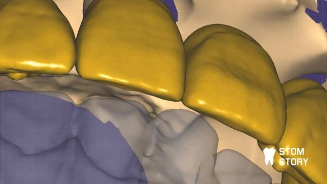 Изготовление балки с уступом ExoCad + B4D ( blender for dental) смотреть онлайн