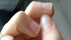 Причины заусенцев на пальцах рук