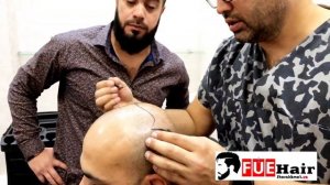 Пересадка волос в Ташкенте