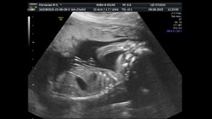 Мой второй УЗИ скрининг - 20 недель.  09.08.2023.