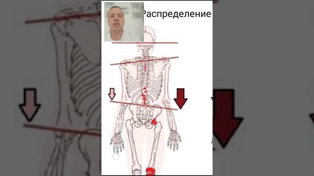 Как за 3 сеанса, без упражнений и корсетов, исправить сколиоз в грудном и поясничном отделе.