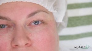 ЛАЗЕРНАЯ БЛЕФАРОПЛАСТИКА   АППАРАТ JOULE