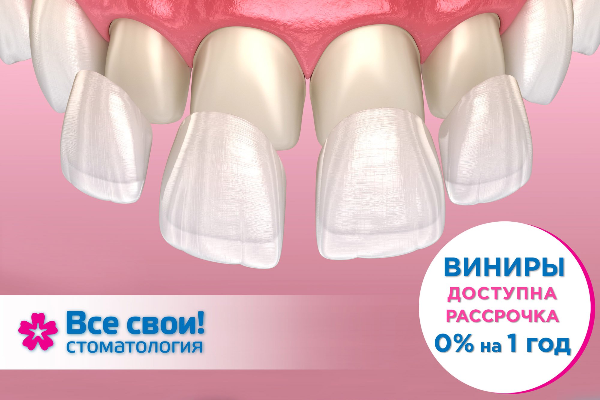 Виниры и люминиры. Эстетическая реставрация зубов. Керамические виниры. Голливудская улыбка.