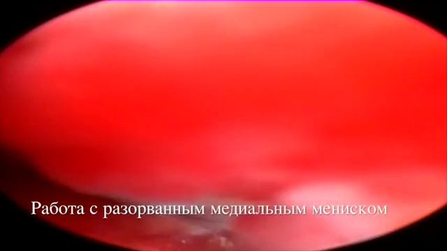 Озвучка  Артроскопия коленного сустава  Разрыв ПКС, повреждения медиального и латерального менисков