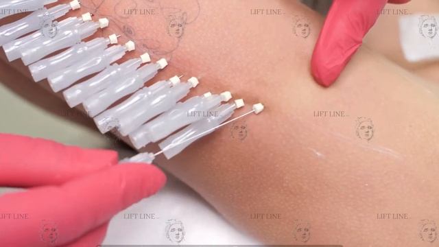 Подтяжка кожи рук нитями смотреть онлайн