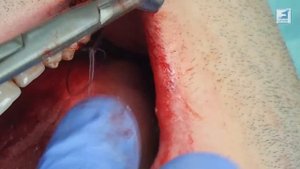 Синуслифтинг, удаление зубов, имплантация, резекция корней зубов, ревизия дна гайморовой пазухи