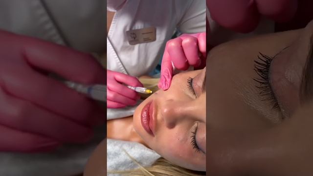 Векторный лифтинг Radiesse для лифтинга и омоложения кожи по выгодной цене в июне? смотреть онлайн