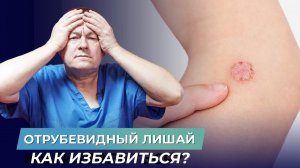 Как вылечить отрубевидный лишай?