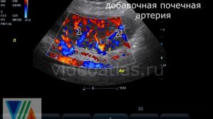 Неполное удвоение почки. Еще пример.