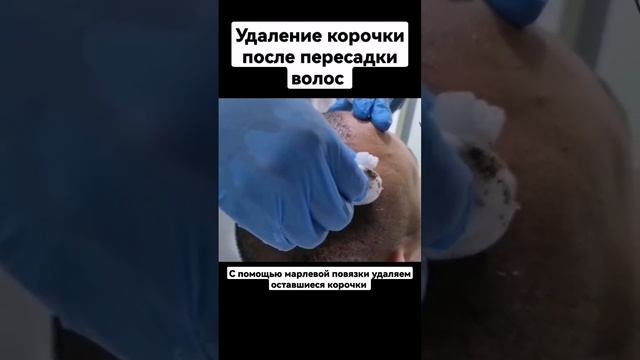 Удаление корочки после пересадки волос #пересадкаволос #пересадкаволосвтурции