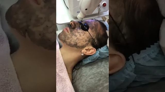 Карбоновый Лазерный Пилинг смотреть онлайн