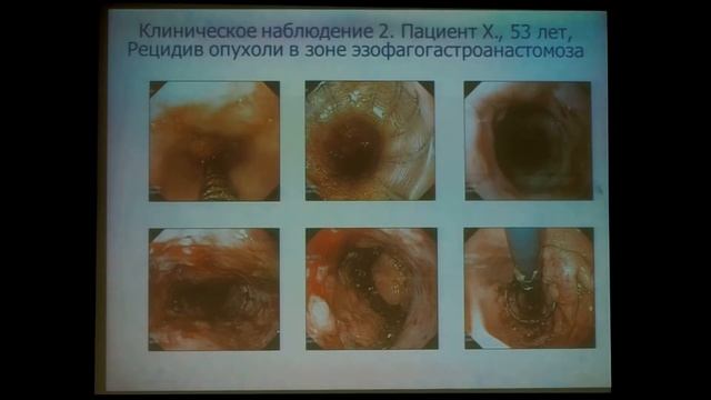 20 Годжелло Э А Осложнения стентирования опухолевых и рубцовых стенозов пищевода металлическим смотреть онлайн