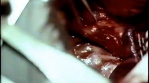 Отравление серной кислотой. Пластика пищевода © Sulfuric acid poisoning. Esophageal plastic surgery