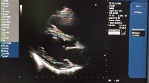 Определение индекса массы миокарда