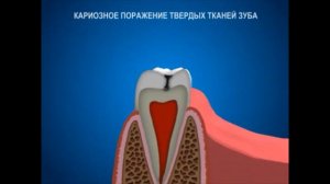 как кариес разрушает зуб