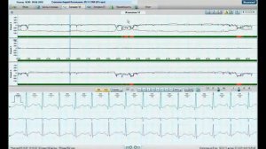 Анализ сегмента ST