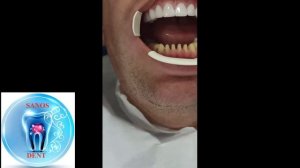 Фиксация циркониевых коронок