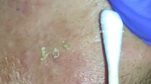 "K's" Best Blackhead Extraction Compilation Part #2