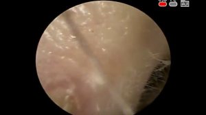 #Фурункул #гнойник наружного #уха лечение в КЛИНИКА ОБРАЗЦОВА