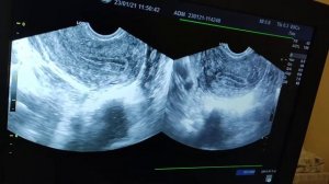 Диагностика полипов полости матки