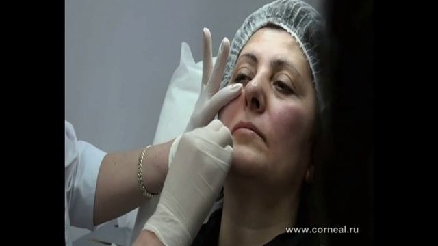 Контурная пластика - а что если есть нити. смотреть онлайн