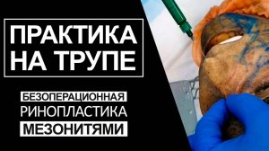 Безоперационная ринопластика мезонитями - практика на трупе