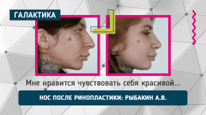 Результат после риносептопластики | Рыбакин Артур Владимирович #пластиканоса