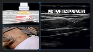 How to Correctly Identify Anatomy for Transversus Abdominis Plane (TAP) Block