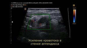 Острый  аппендицит на УЗИ (10-5-18)