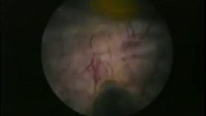 Дробление камня в мочевом пузыре.MPG