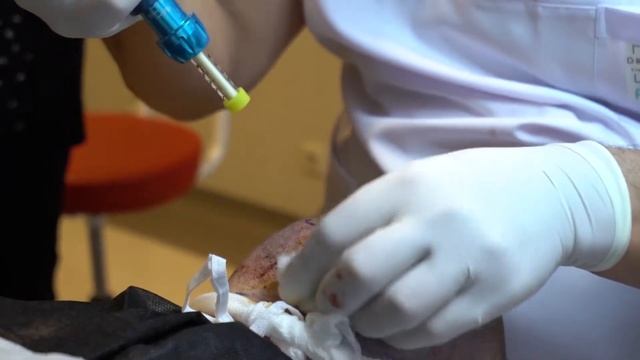 Hair Transplant Process with Dr. Turan: Local anesthetic смотреть онлайн