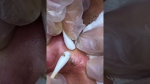 Самое залипательное видео давить прыщи Черные точки