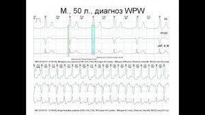 WPW и смещение сегмента ST на ЭКГ