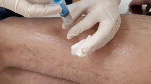 Thigh Block Injection Блокада бедра Триггерная зона Лечение боли