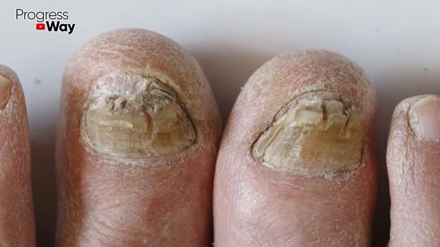 Вот, Как Убрать Грибок за 1 Минуту РАЗ И НАВСЕГДА. Избавься От ГРИБКА Ногтей На Ногах! смотреть онлайн