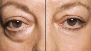 Как быстро избавиться от мешков под глазами?